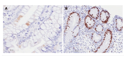 Viêm đại tràng do Cytomegalovirus.