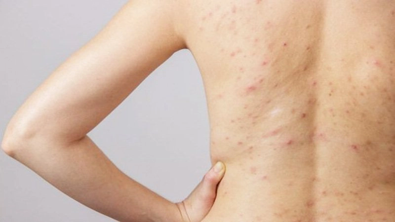 dấu hiệu viêm nang lông