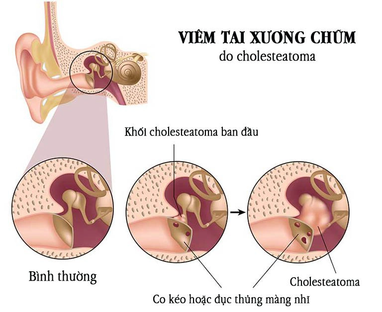 viêm tai xương chũm trường hợp cholesteatoma
