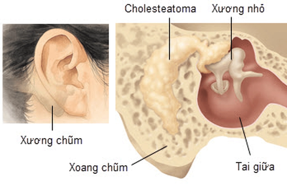Viêm tai xương chũm