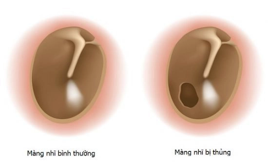 Thủng màng nhĩ