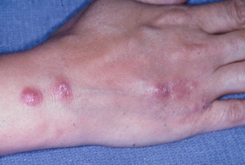 Bệnh Sarcoidosis