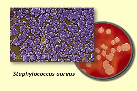 Staphylococcus aureus