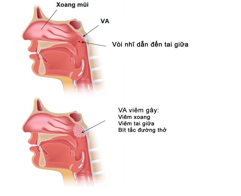 trẻ viêm VA
