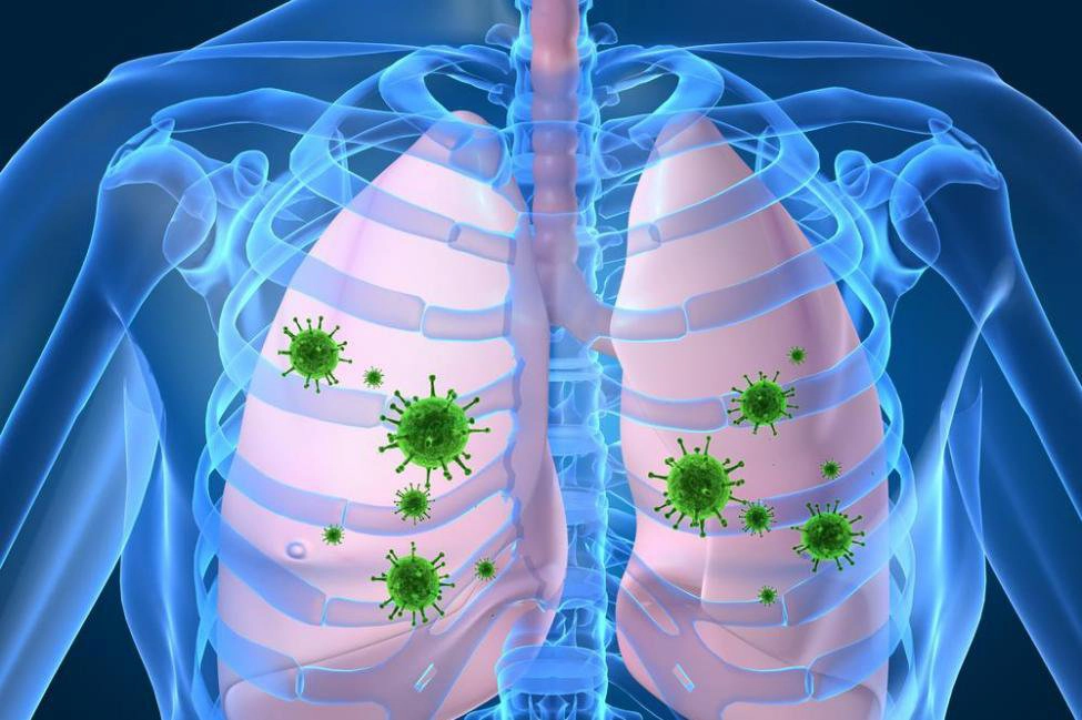 Viêm phổi do virus