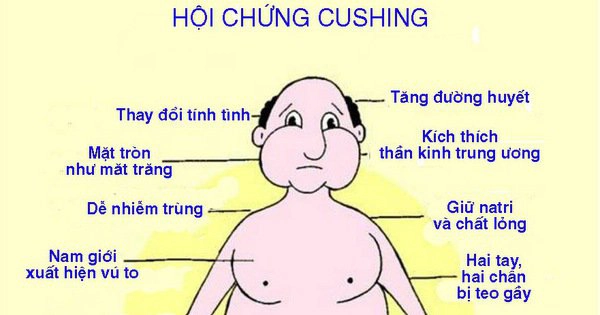 hội chứng Cushing
