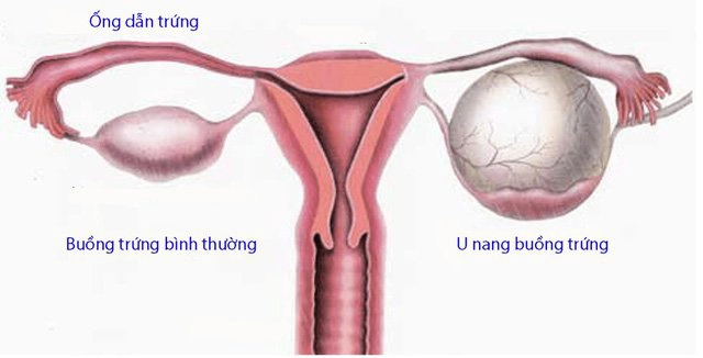 Các yếu tố gây suy giảm buồng trứng sớm