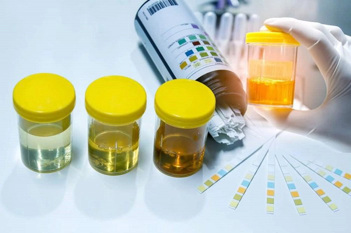 Xét nghiệm tinh thể trong nước tiểu thường được chỉ định trong trường hợp nghi nhiễm sỏi thận