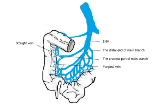 Minh  họa bằng đồ thị về sự phân bố vôi hóa trong tĩnh mạch mạc treo tràng trên. SMV: Tĩnh mạch mạc treo tràng trên.