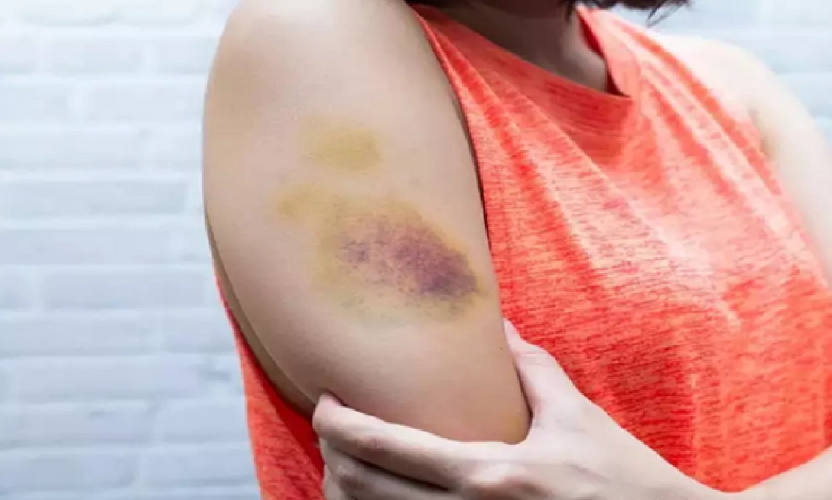 vết bầm vàng trên da