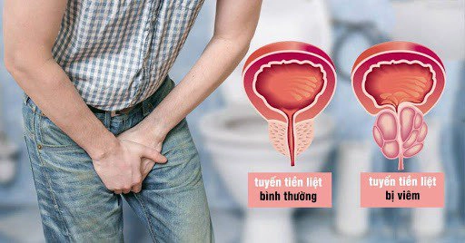 rối loạn tuyến tiền liệt