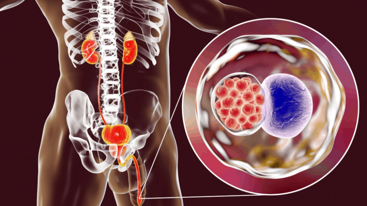 vi khuẩn đường sinh dục như Chlamydia và trichomonas