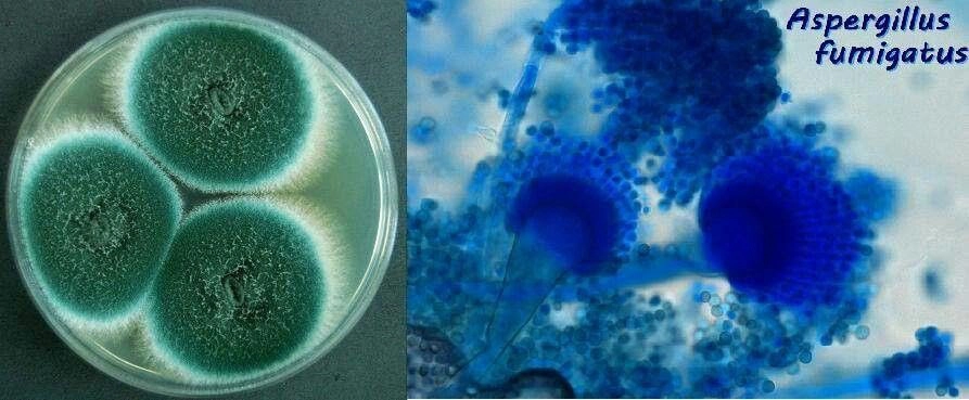 xét nghiệm aspergillus galactomannan