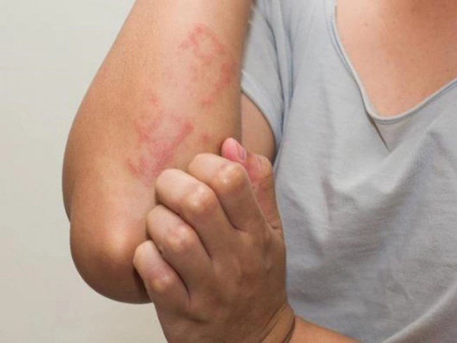 12 cách tự nhiên để “đánh bại” dị ứng