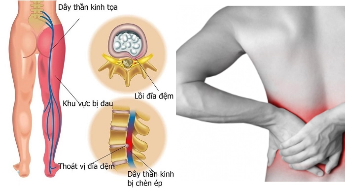 5 phút để biết cách phòng thoát vị đĩa đệm