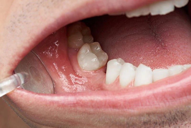 9 yếu tố rủi ro dẫn đến mất răng