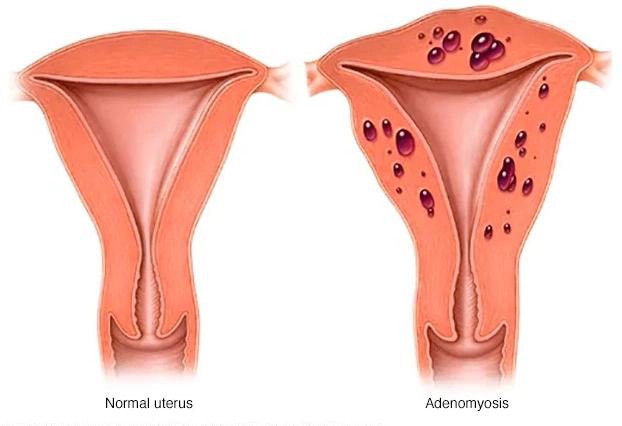 Adenomyosis là bệnh gì?
