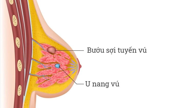 Ảnh hưởng của bướu sợi tuyến