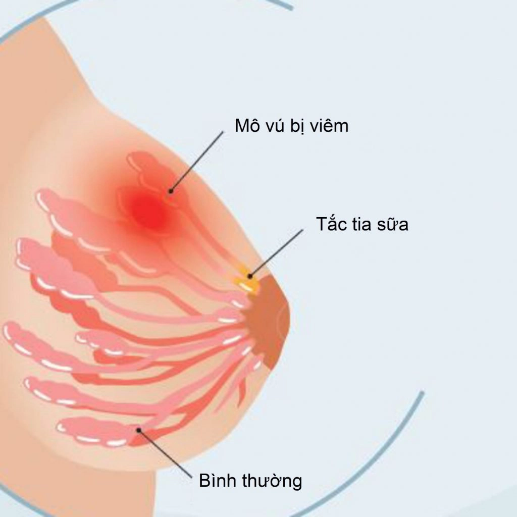 Áp xe vú điều trị như thế nào?