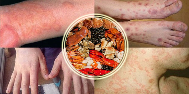 Bà bầu bị dị ứng hải sản phải làm sao?
