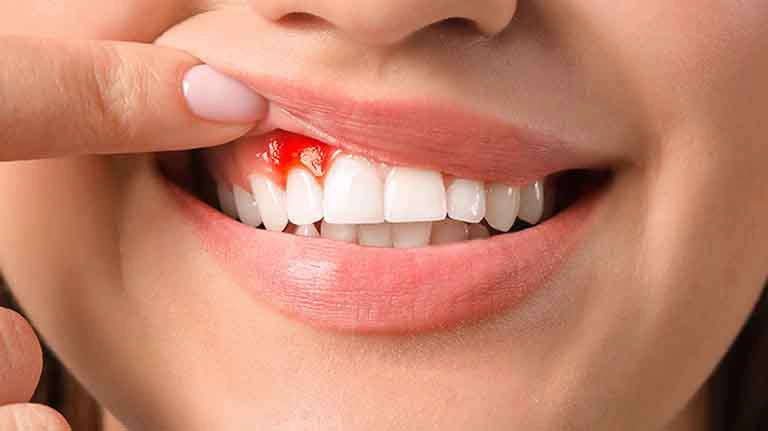 Bà bầu bị sưng lợi phải làm sao cho hết?