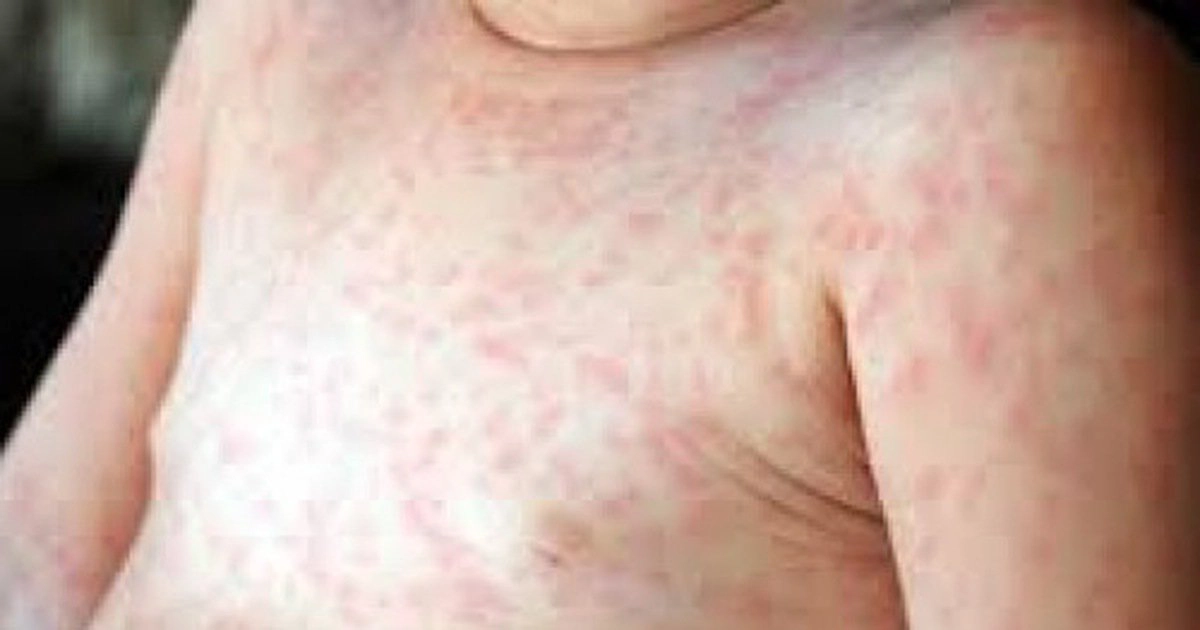 Ban sởi mọc như thế nào?