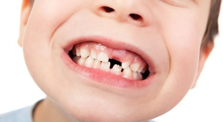 Bé răng nhổ lâu mọc lại, có cần đi khám?