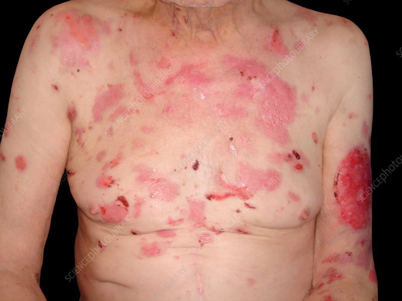 Bệnh bọng nước dạng PEMPHIGUS: Dấu hiệu, nguyên nhân và cách điều trị