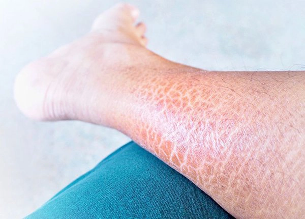 Bệnh da vảy cá (harlequin ichthyosis)