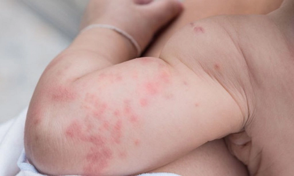 Bệnh đậu mùa có nguy hiểm không?