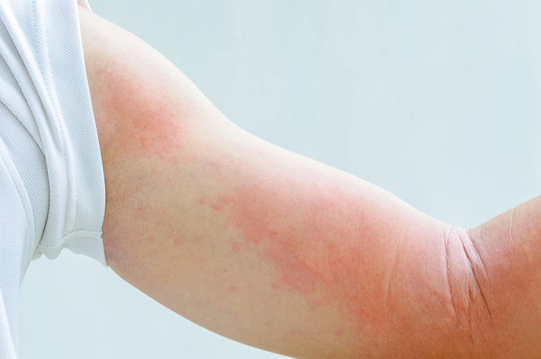 Bệnh mề đay ánh sáng mặt trời là gì?