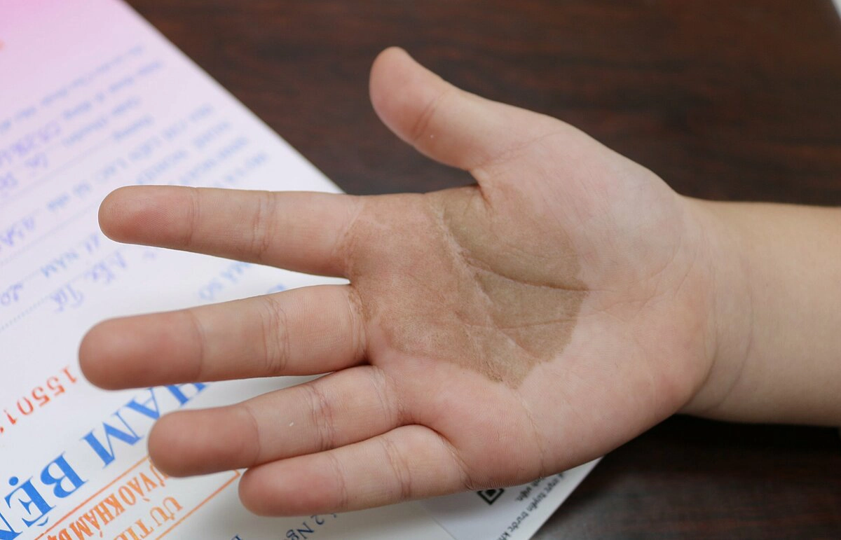Bệnh nấm đen là gì?