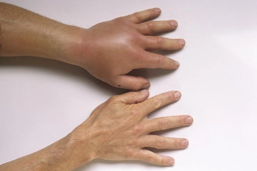 Bệnh phù mạch di truyền: Nguyên nhân, chẩn đoán và điều trị