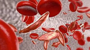 Bệnh thiếu máu Thalassemia (tan máu bẩm sinh)