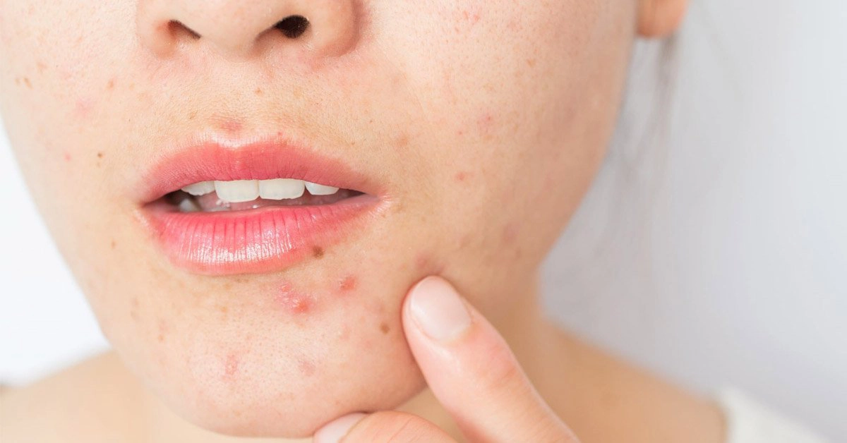 Bệnh trứng cá đỏ là bệnh gì?
