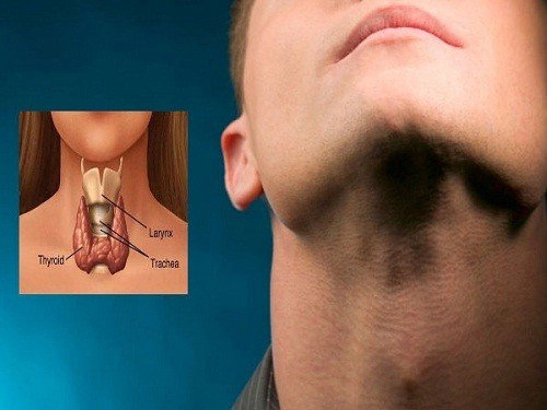 Bệnh u tuyến giáp và bướu cổ có khác nhau không?