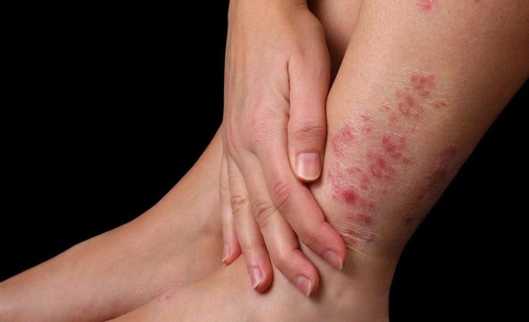 Bệnh vảy nến mặc vải gì? 10 lời khuyên để chọn quần áo và giường ngủ phù hợp với bệnh vẩy nến