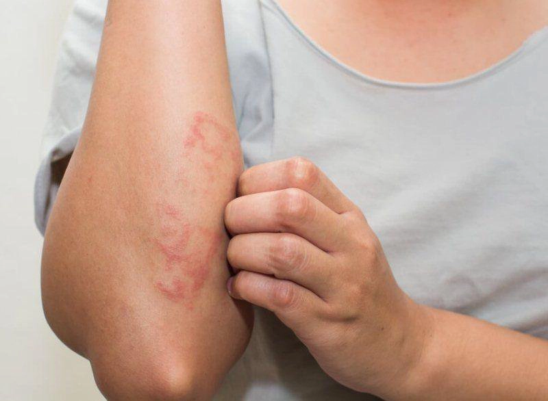 Bệnh vảy phấn hồng gibert: Dấu hiệu lâm sàng và chẩn đoán điều trị