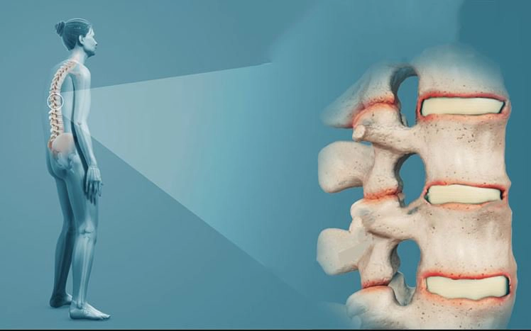 Bệnh viêm cột sống dính khớp có ảnh hưởng đến sinh sản không?