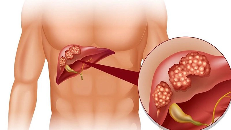Bệnh viêm gan B có lây qua đường hô hấp không?