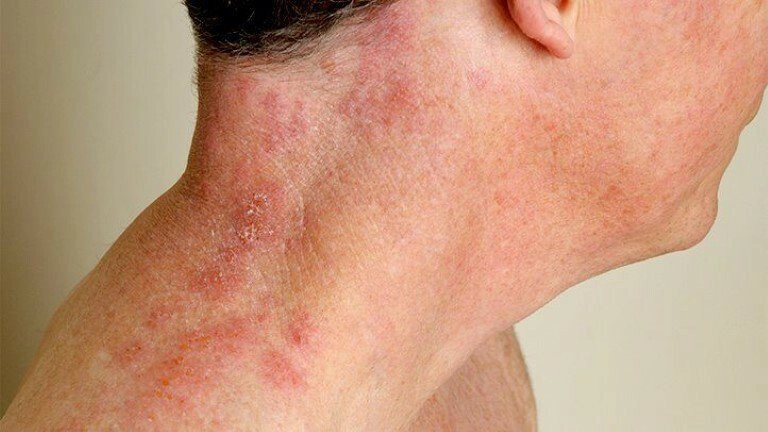 Bệnh Zona thần kinh có chữa khỏi được không?