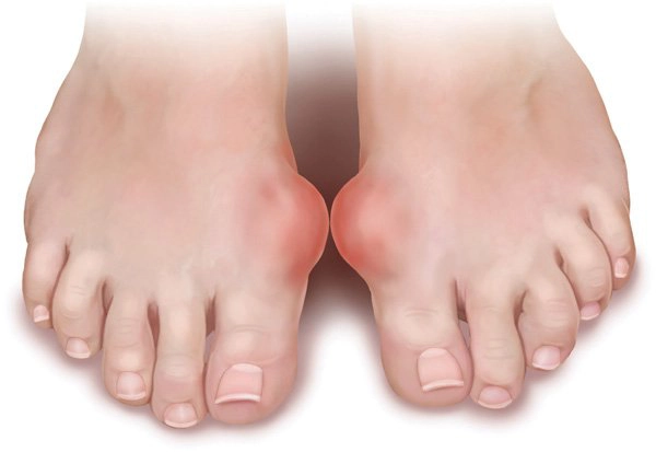 Bị bệnh gút ăn trứng được không?