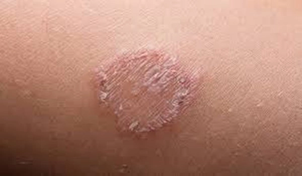 Bị bệnh hắc lào và cách chữa hiệu quả