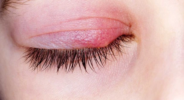 Bị ngứa mi mắt liên tục, coi chừng viêm bờ mi