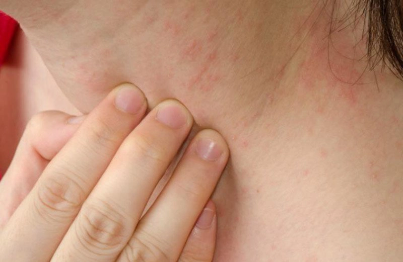 Bị nổi mẩn ngứa khắp người không rõ nguyên nhân