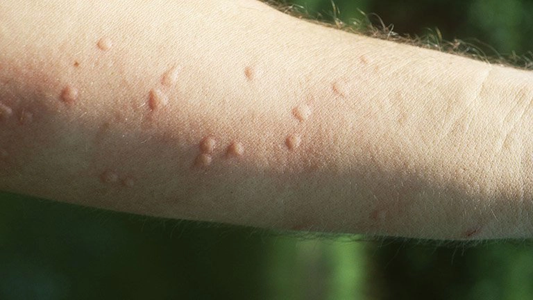 Bị nổi mề đay kiêng gì để giảm mẩn ngứa?