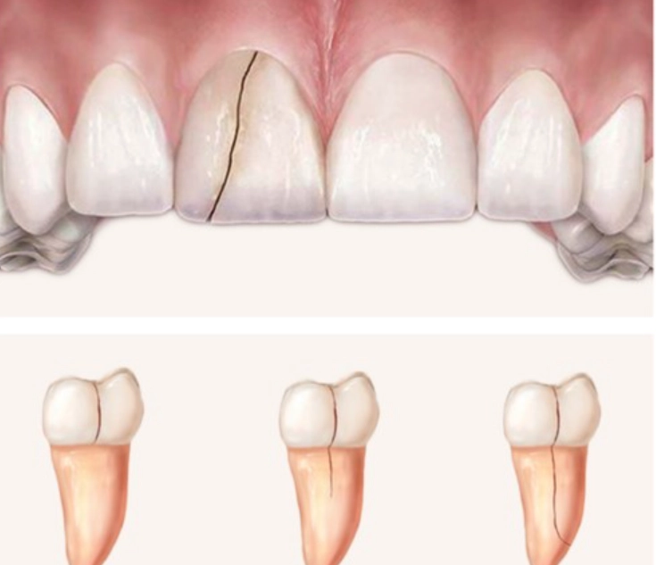 Bị nứt răng có nguy hiểm và có tự lành không?