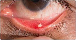 Bị sạn vôi mắt có tự khỏi không?