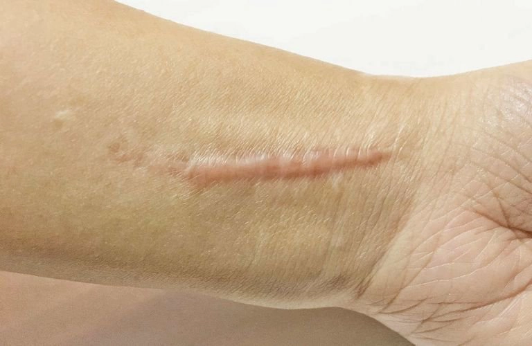 Bị sẹo phì đại thì bao lâu khỏi?