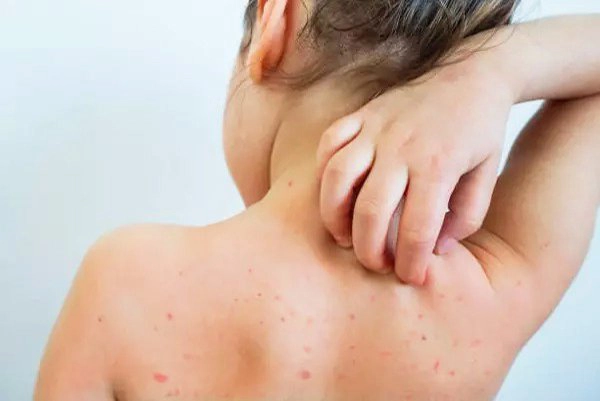 Bị sốt xuất huyết có kiêng gió không?